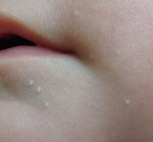 Close-up of skin with milia near the mouth.