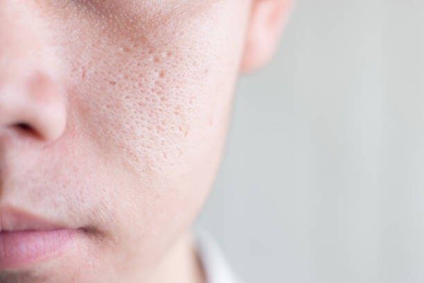 Close-up of a person's face showing enlarged pores on the cheek near the nose and mouth.