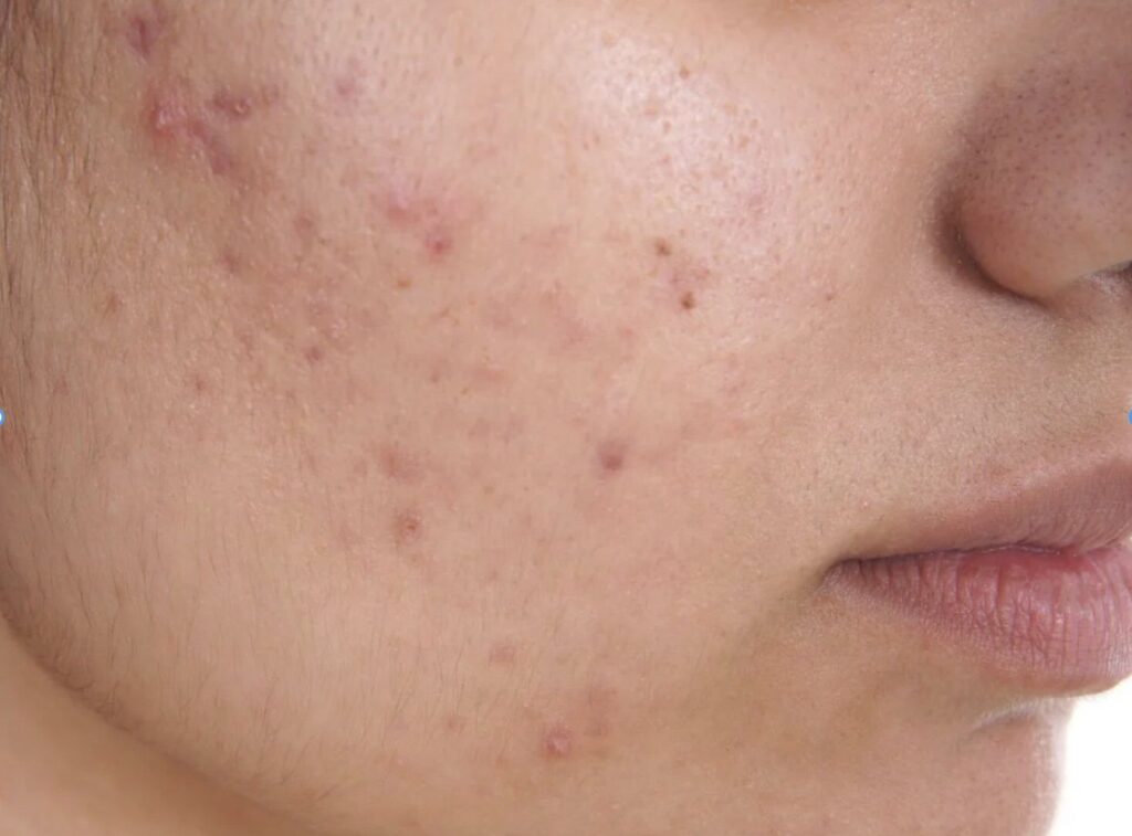 Close-up of a person's cheek with acne and scarring, showing skin texture and tone.