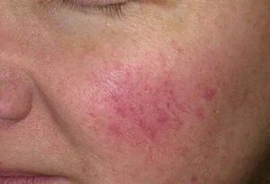 Close-up view of a person's face with redness and visible blood vessels on the cheek area, possibly indicating rosacea.