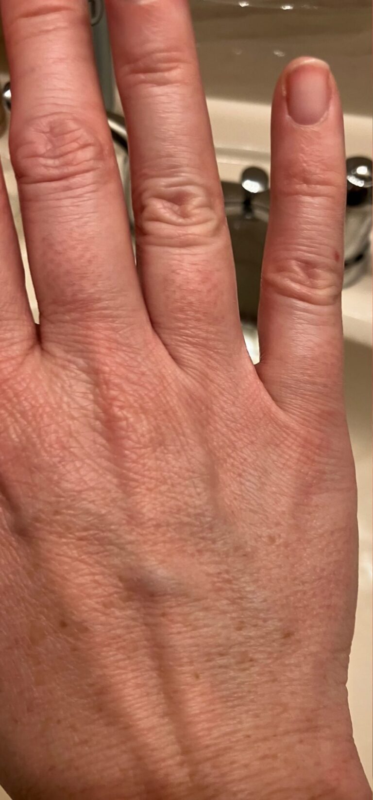 Close-up view of a person's hand showing veins, wrinkles, and skin discoloration.