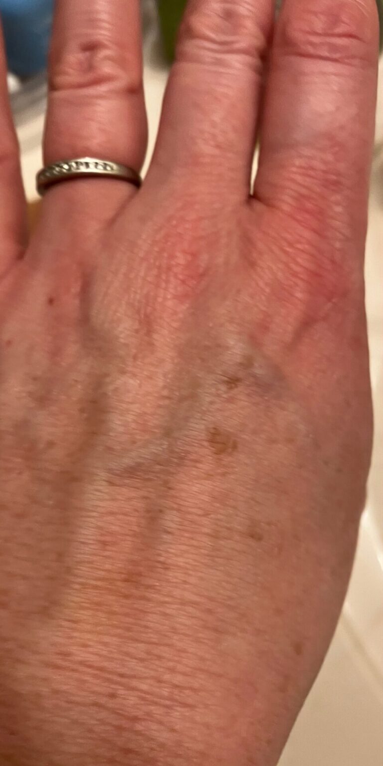 Close-up of a hand with a silver ring on the ring finger and visible veins and age spots.