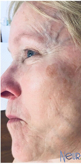 Profile of a woman with age spots and wrinkles, looking to the left.