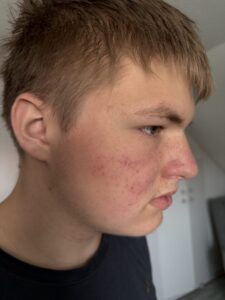 Close-up of a fair-skinned young man's face, shown in profile, with some facial redness and freckles.