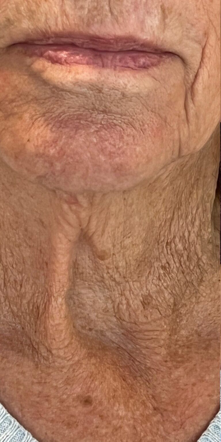 Close-up of an older person's lower face, neck and upper chest area showing skin texture and wrinkles.