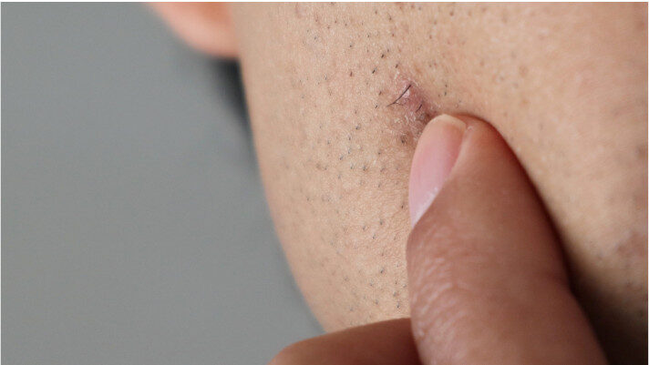 Close-up of a person's face with a finger touching an ingrown hair on the cheek.